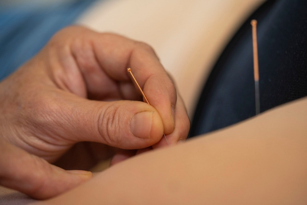 Acupuncture
